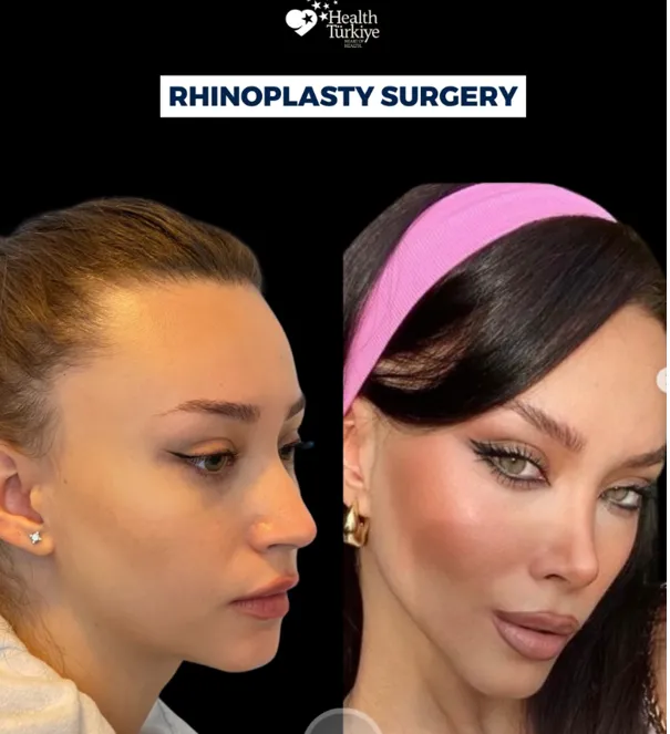 Türkiye’nin En İyi Rinoplasti Doktorları (2026 Liste)